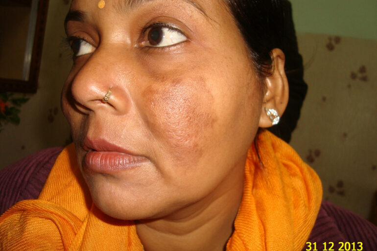 Cure of Long Term Chloasma and Migraine With Homeopathy