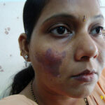 Cure of Long Term Chloasma and Migraine With Homeopathy