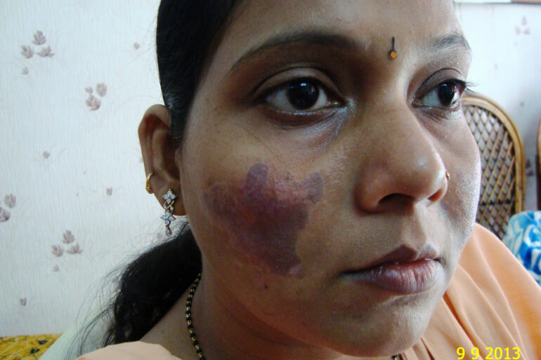 Cure of Long Term Chloasma and Migraine With Homeopathy