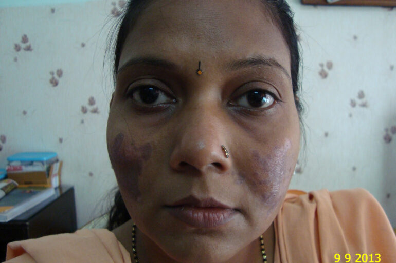 Cure of Long Term Chloasma and Migraine With Homeopathy