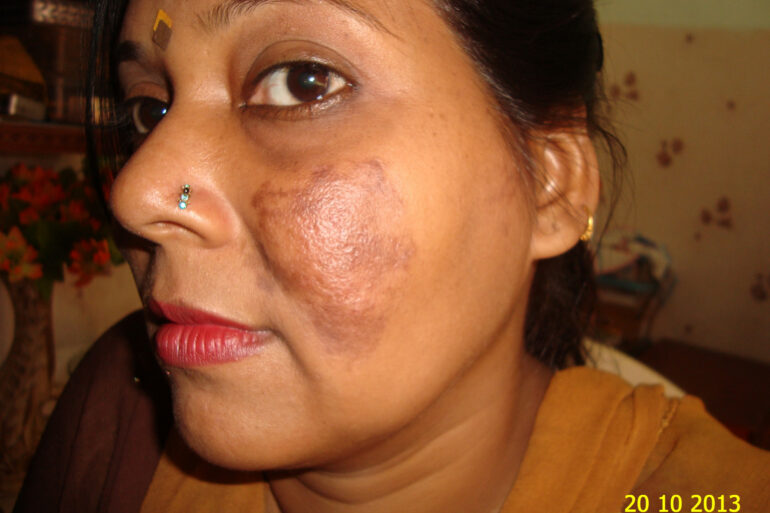 Cure of Long Term Chloasma and Migraine With Homeopathy