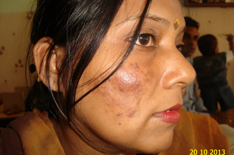 Cure of Long Term Chloasma and Migraine With Homeopathy