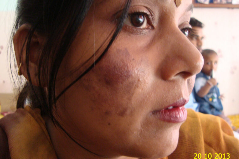 Cure of Long Term Chloasma and Migraine With Homeopathy