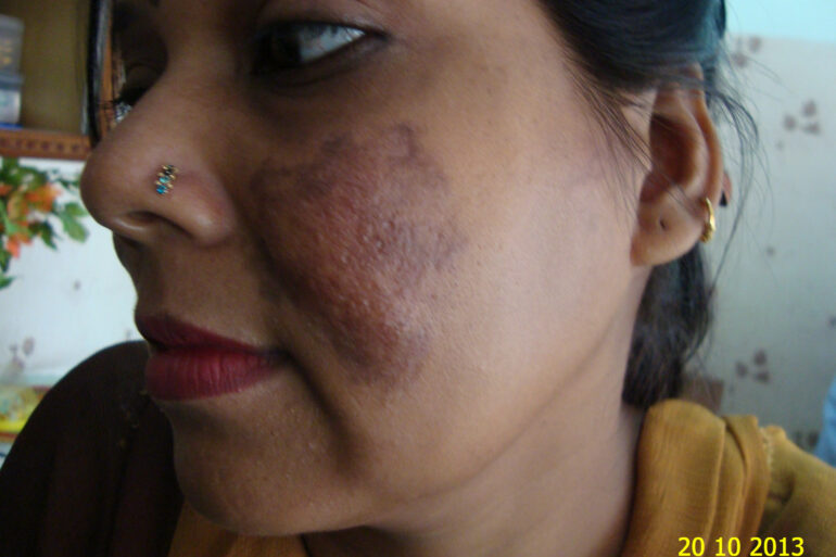 Cure of Long Term Chloasma and Migraine With Homeopathy