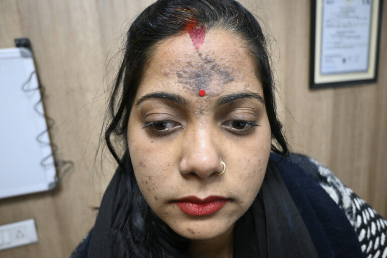 Amazing cure of Flat Warts or Verruca Plana – Case from Varanasi