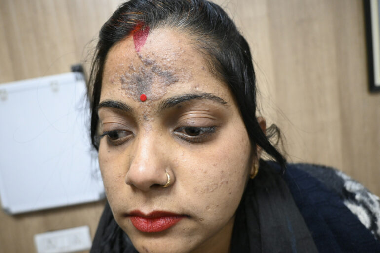 Amazing cure of Flat Warts or Verruca Plana – Case from Varanasi