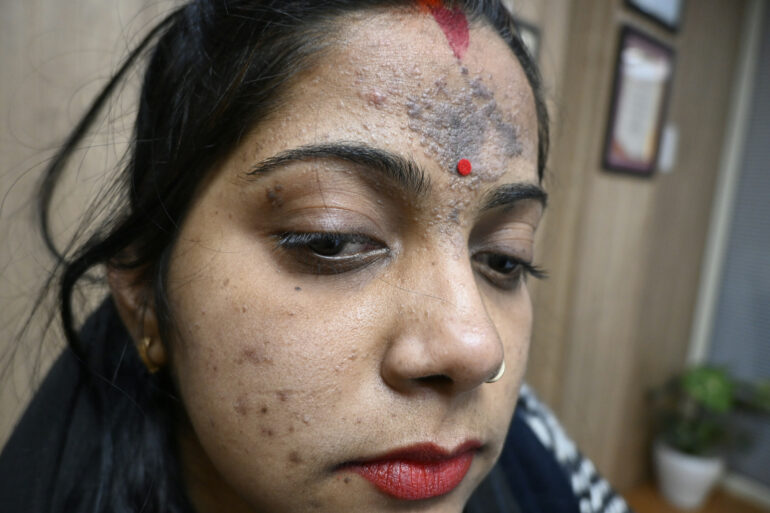 Amazing cure of Flat Warts or Verruca Plana – Case from Varanasi