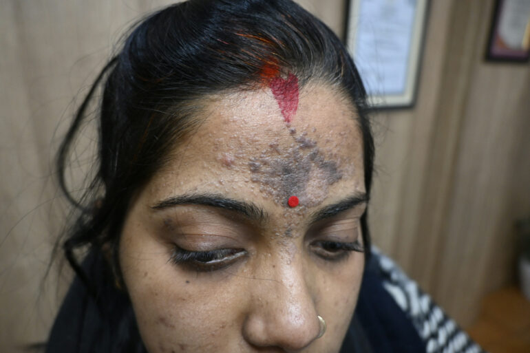 Amazing cure of Flat Warts or Verruca Plana – Case from Varanasi