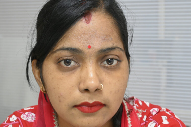 Amazing cure of Flat Warts or Verruca Plana – Case from Varanasi