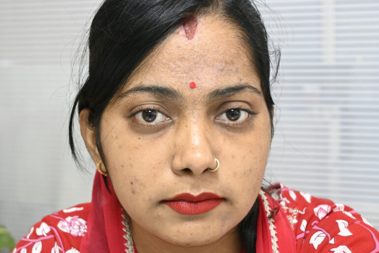 Amazing cure of Flat Warts or Verruca Plana – Case from Varanasi