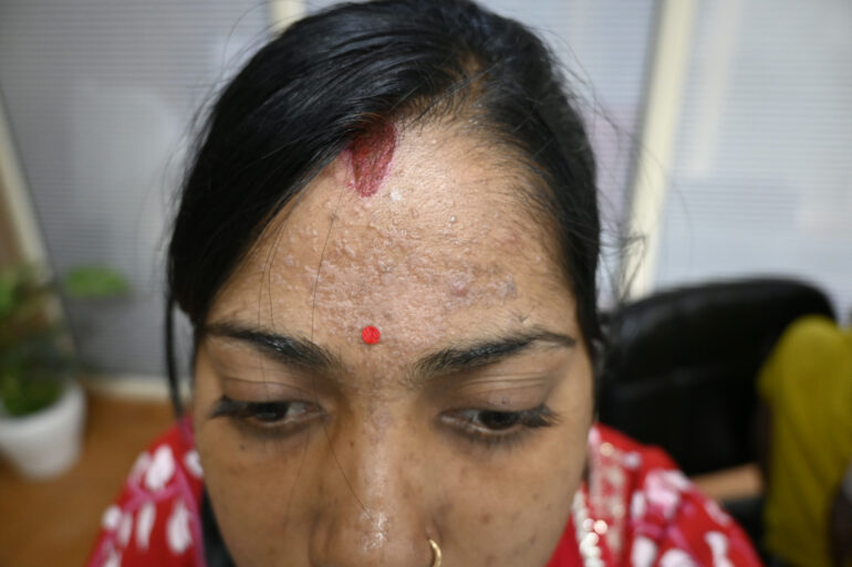 Amazing cure of Flat Warts or Verruca Plana – Case from Varanasi