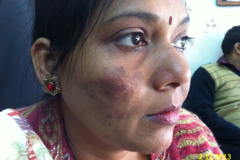 Cure of Long Term Chloasma and Migraine With Homeopathy