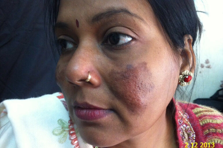 Cure of Long Term Chloasma and Migraine With Homeopathy