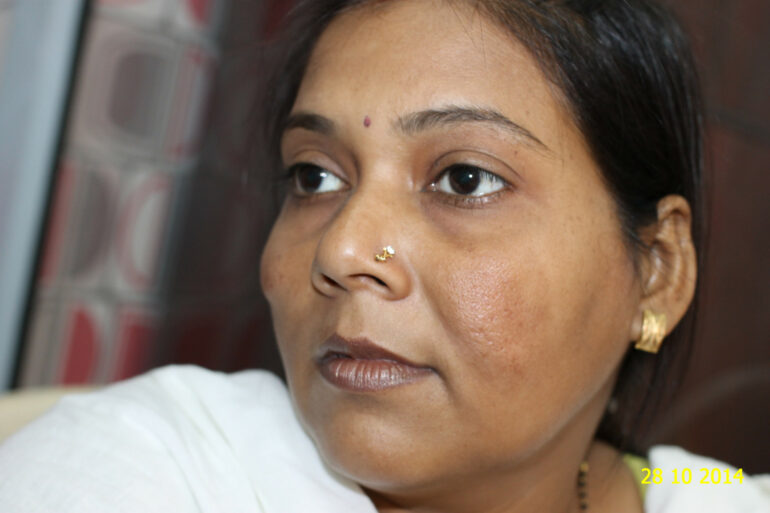 Cure of Long Term Chloasma and Migraine With Homeopathy