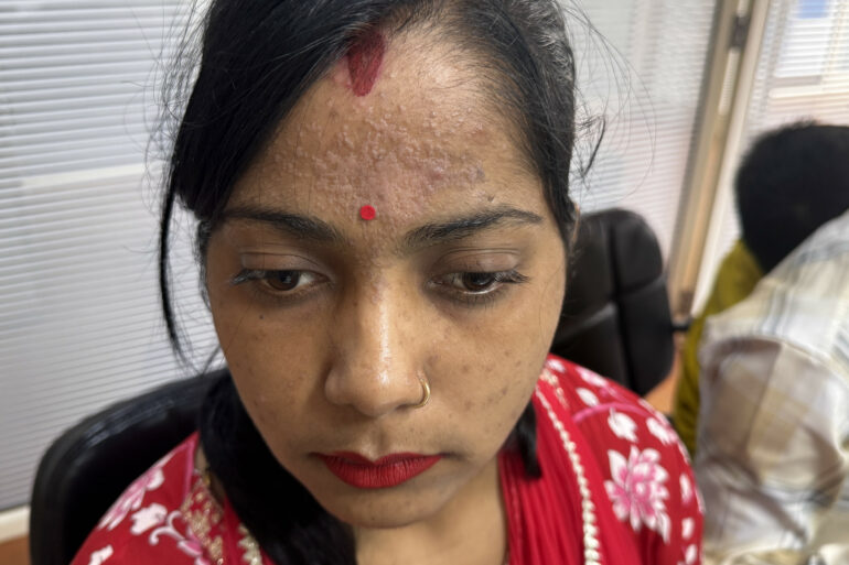 Amazing cure of Flat Warts or Verruca Plana – Case from Varanasi