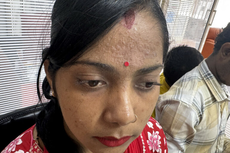 Amazing cure of Flat Warts or Verruca Plana – Case from Varanasi