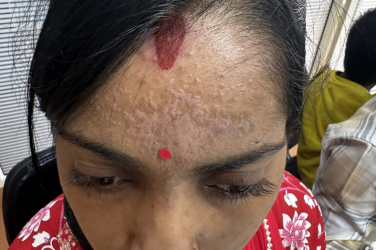 Amazing cure of Flat Warts or Verruca Plana – Case from Varanasi