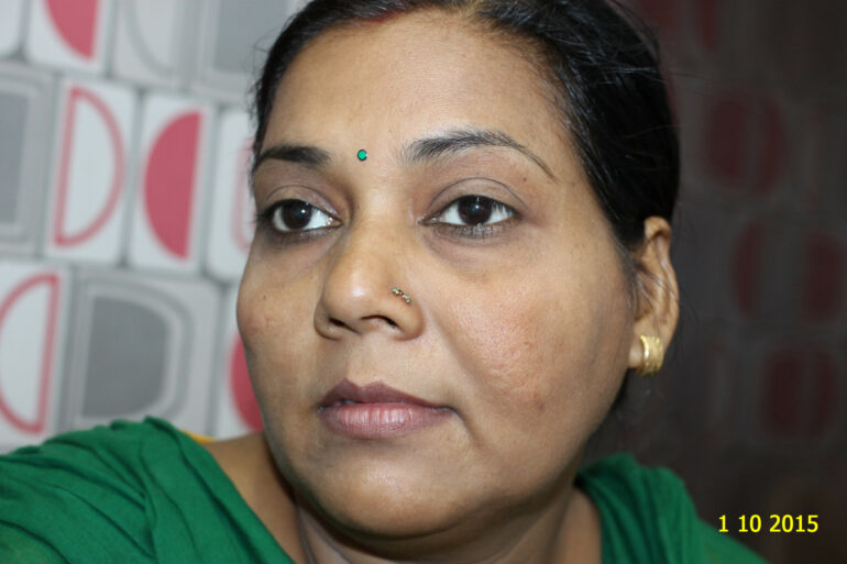 Cure of Long Term Chloasma and Migraine With Homeopathy