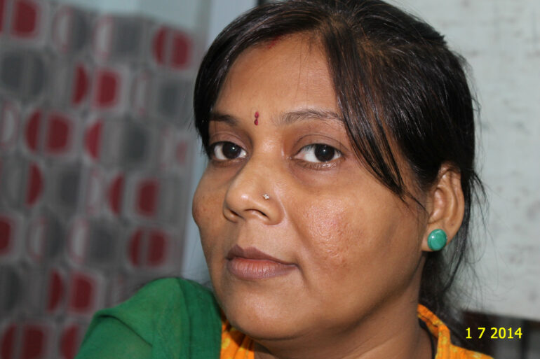 Cure of Long Term Chloasma and Migraine With Homeopathy