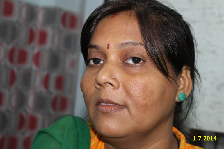 Cure of Long Term Chloasma and Migraine With Homeopathy