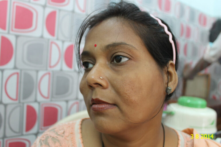 Cure of Long Term Chloasma and Migraine With Homeopathy