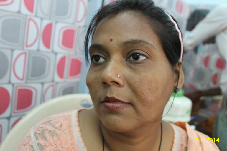 Cure of Long Term Chloasma and Migraine With Homeopathy