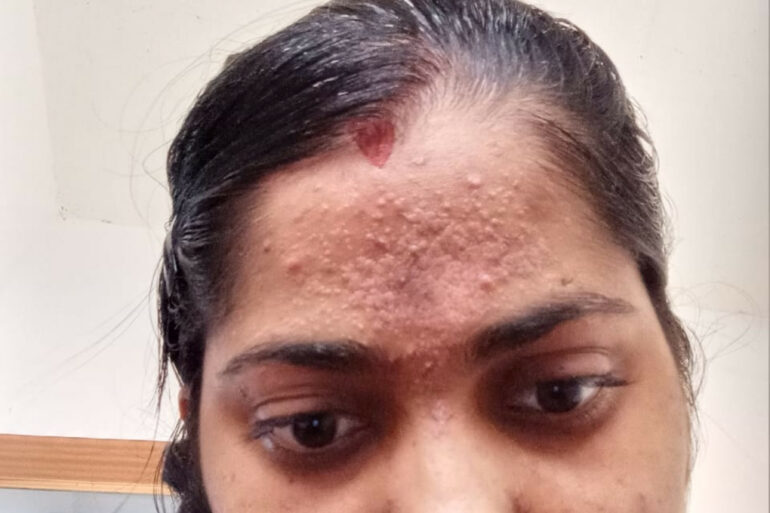 Amazing cure of Flat Warts or Verruca Plana – Case from Varanasi