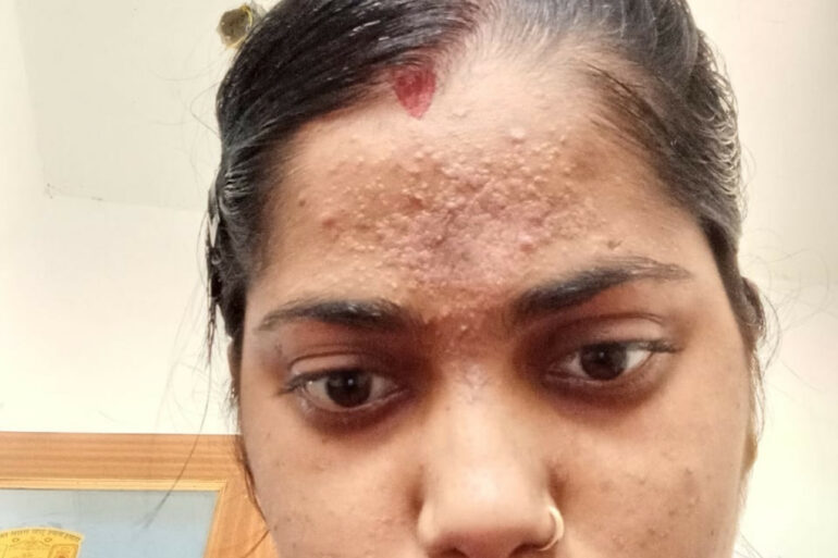 Amazing cure of Flat Warts or Verruca Plana – Case from Varanasi