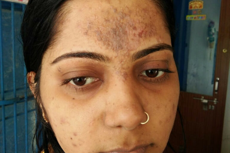 Amazing cure of Flat Warts or Verruca Plana – Case from Varanasi