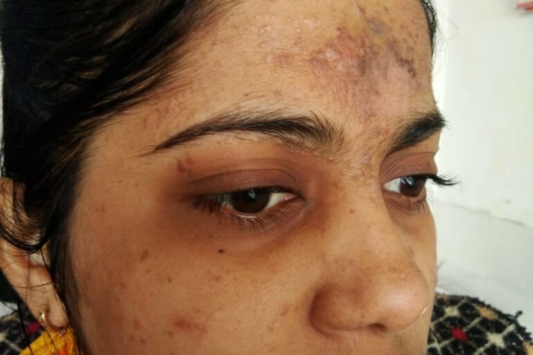 Amazing cure of Flat Warts or Verruca Plana – Case from Varanasi