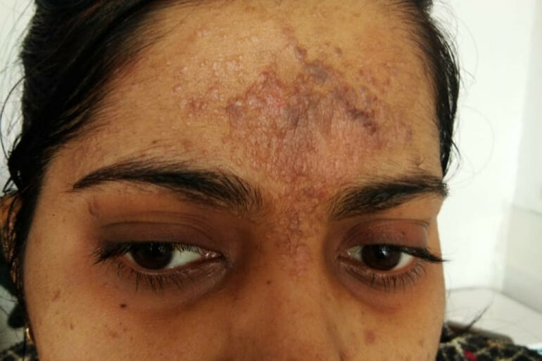 Amazing cure of Flat Warts or Verruca Plana – Case from Varanasi