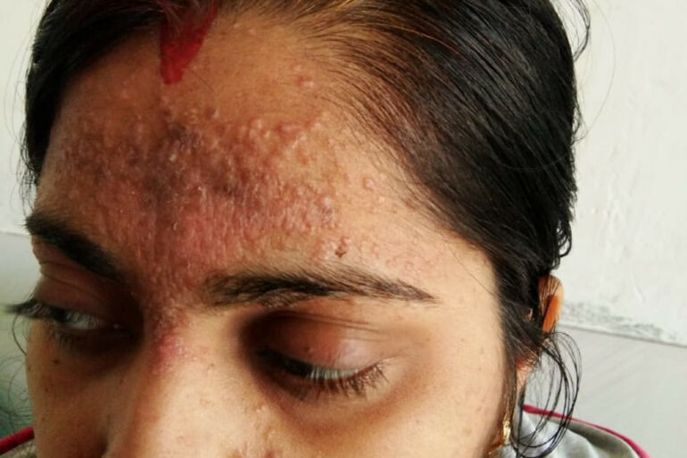 Amazing cure of Flat Warts or Verruca Plana – Case from Varanasi
