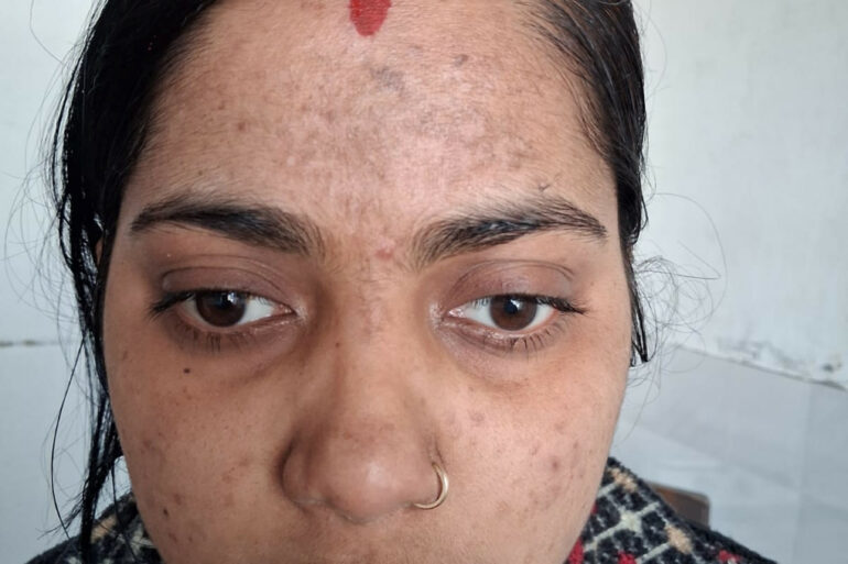 Amazing cure of Flat Warts or Verruca Plana – Case from Varanasi