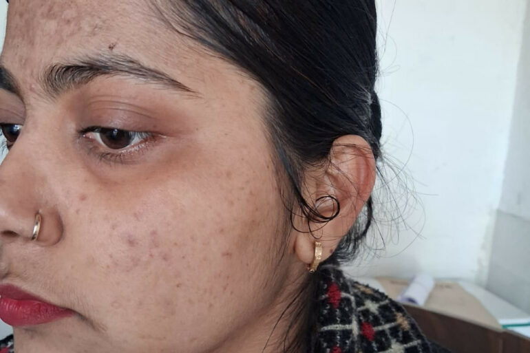 Amazing cure of Flat Warts or Verruca Plana – Case from Varanasi