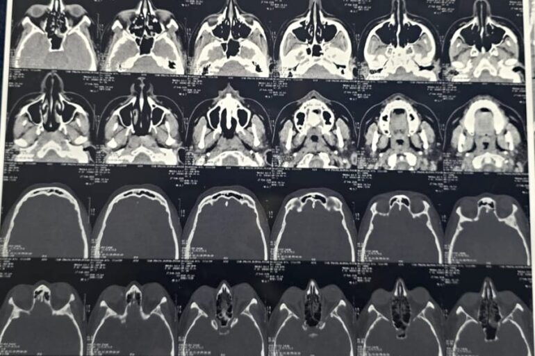 Quick recovery in 3 days- Case of CSF Rhinorrhea from Patiala