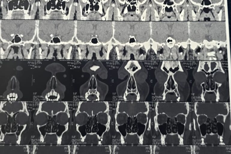 Quick recovery in 3 days- Case of CSF Rhinorrhea from Patiala