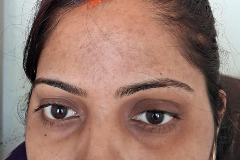 Amazing cure of Flat Warts or Verruca Plana – Case from Varanasi