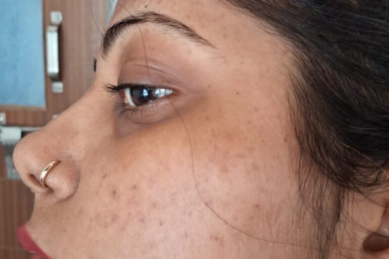 Amazing cure of Flat Warts or Verruca Plana – Case from Varanasi