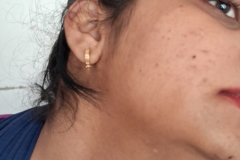 Amazing cure of Flat Warts or Verruca Plana – Case from Varanasi