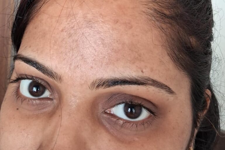 Amazing cure of Flat Warts or Verruca Plana – Case from Varanasi