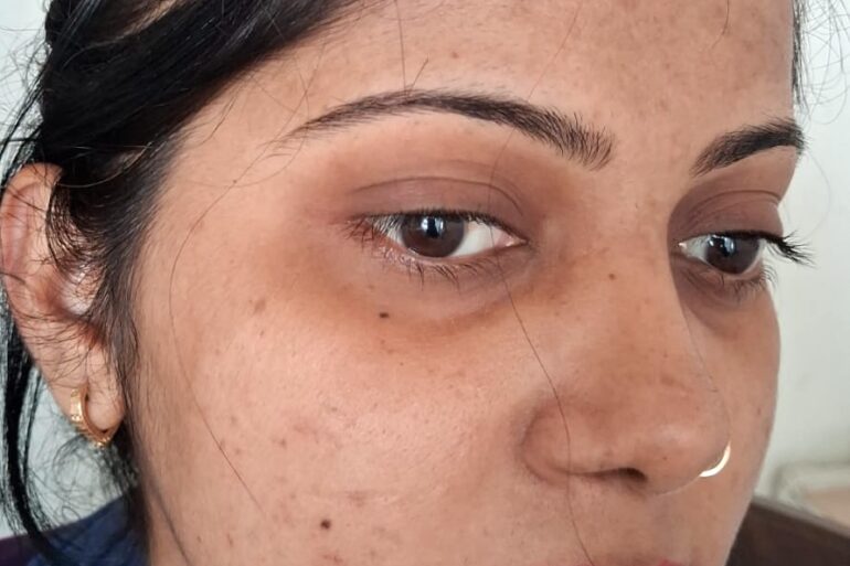 Amazing cure of Flat Warts or Verruca Plana – Case from Varanasi