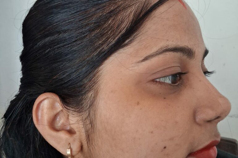 Amazing cure of Flat Warts or Verruca Plana – Case from Varanasi