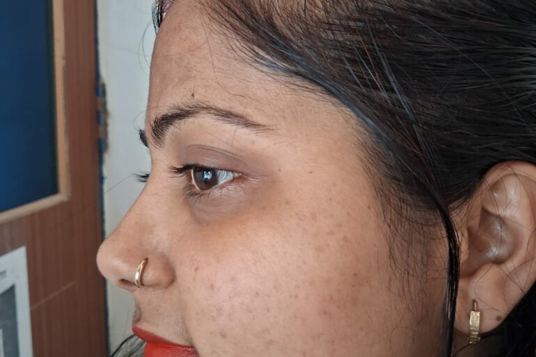 Amazing cure of Flat Warts or Verruca Plana – Case from Varanasi