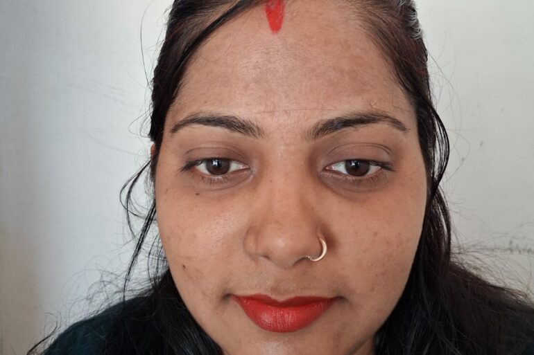 Amazing cure of Flat Warts or Verruca Plana – Case from Varanasi