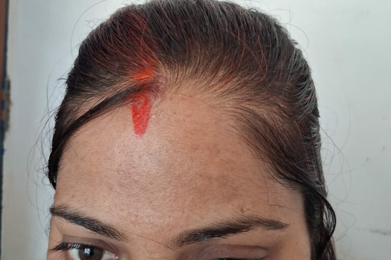 Amazing cure of Flat Warts or Verruca Plana – Case from Varanasi