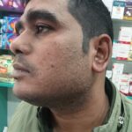 Warts for 1 Years and Chronic Allergic Rhinitis got cured in 10 Days !!!!!