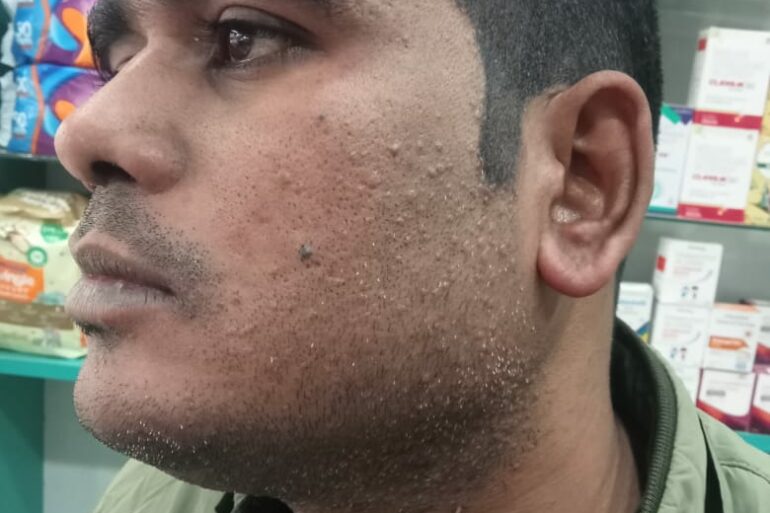 Warts for 1 Years and Chronic Allergic Rhinitis got cured in 10 Days !!!!!