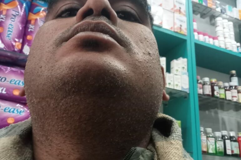 Warts for 1 Years and Chronic Allergic Rhinitis got cured in 10 Days !!!!!