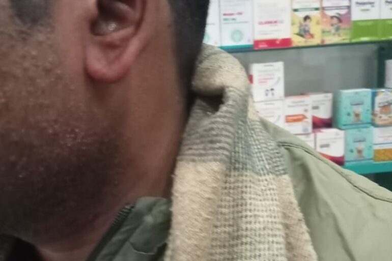 Warts for 1 Years and Chronic Allergic Rhinitis got cured in 10 Days !!!!!