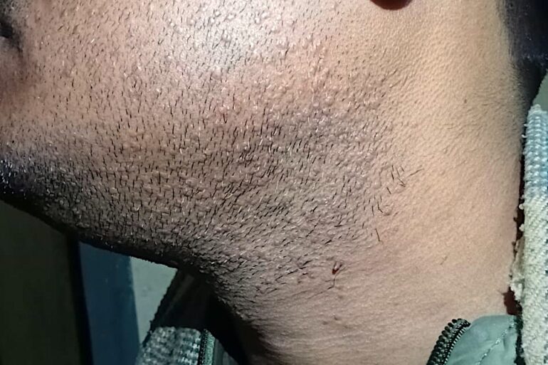 Warts for 1 Years and Chronic Allergic Rhinitis got cured in 10 Days !!!!!